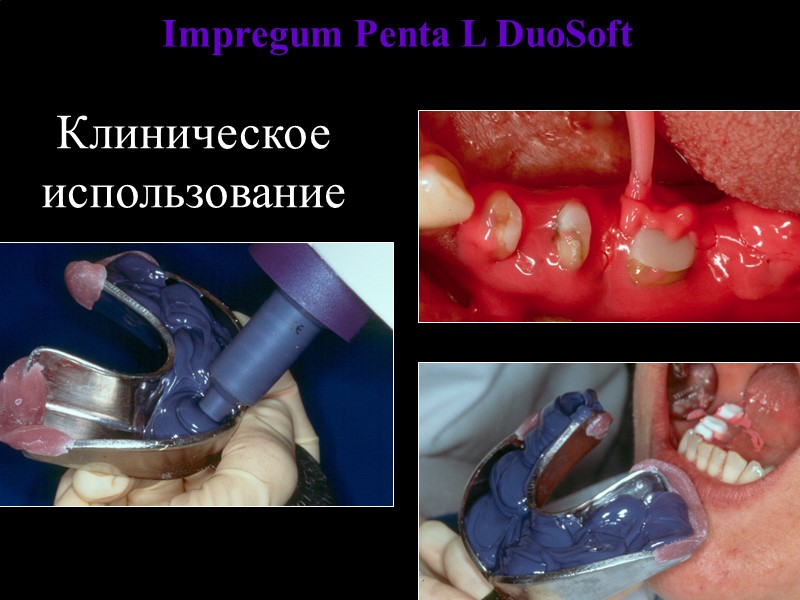 Клиническое использование Impregum Penta L DuoSoft